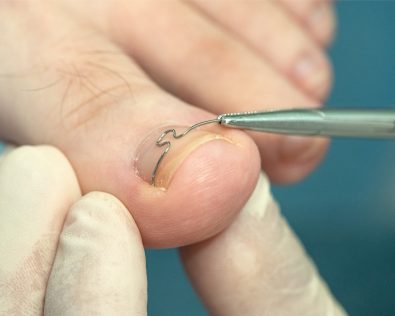 Chirurgie du pied: quand faut-il le faire?